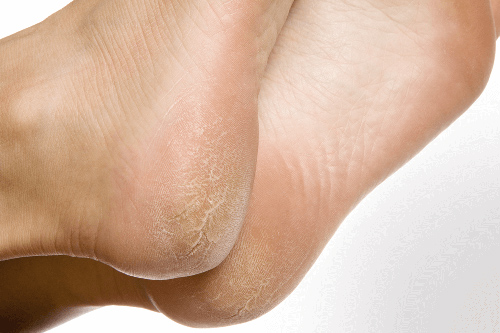 Como prevenir e remover calosidades dos pés