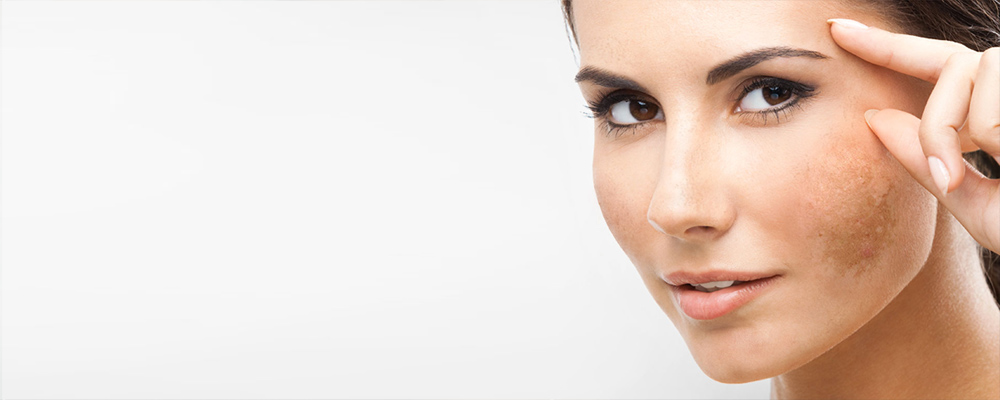Melasma