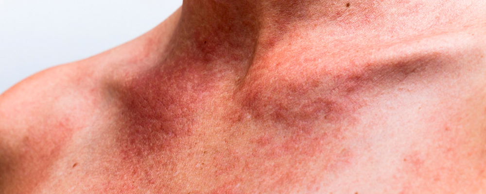 Remoção de manchas causadas pelo sol